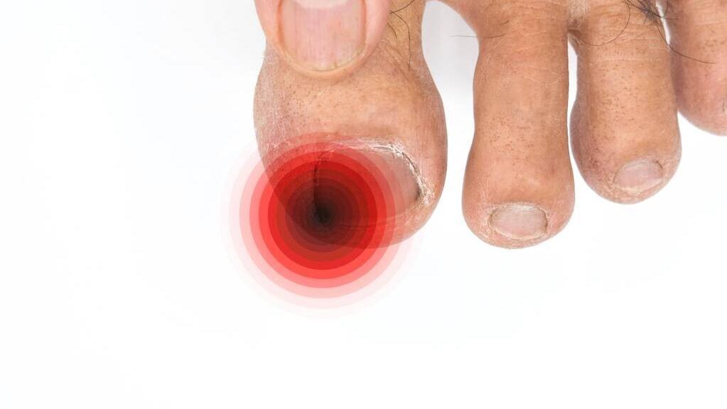 专业治疗灰指甲脚气甲沟炎,灰指甲脚趾甲沟炎用什么药