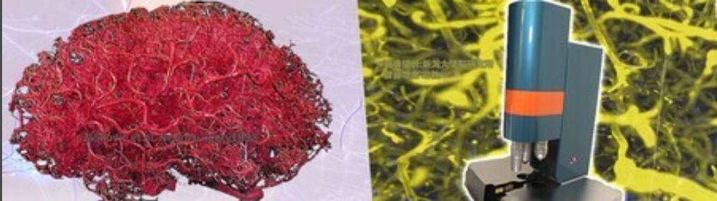 干细胞治疗阿尔茨海默病,日本干细胞疗法治疗脑血管病