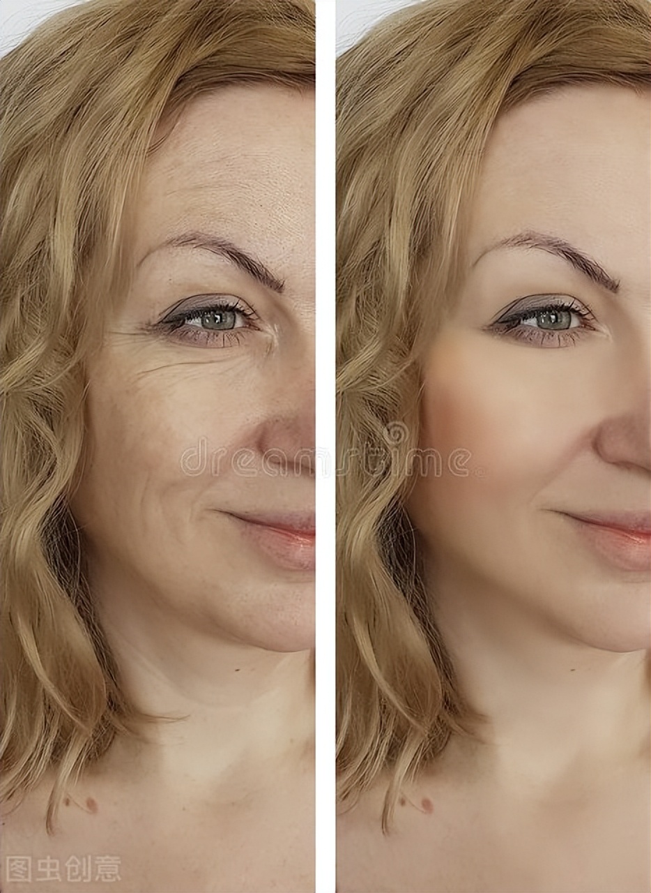 拉皮抗衰老最多能做几次,拉皮和青春定格哪个抗衰老效果好