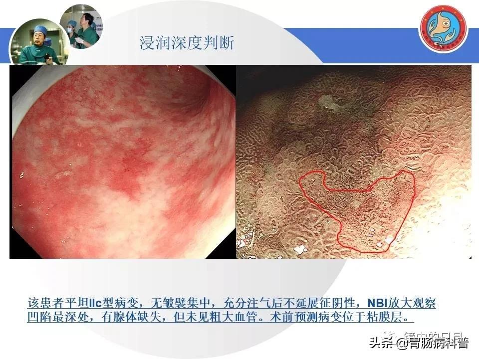 胃癌可以做内镜手术吗,早期胃癌内镜手术后追加外科手术