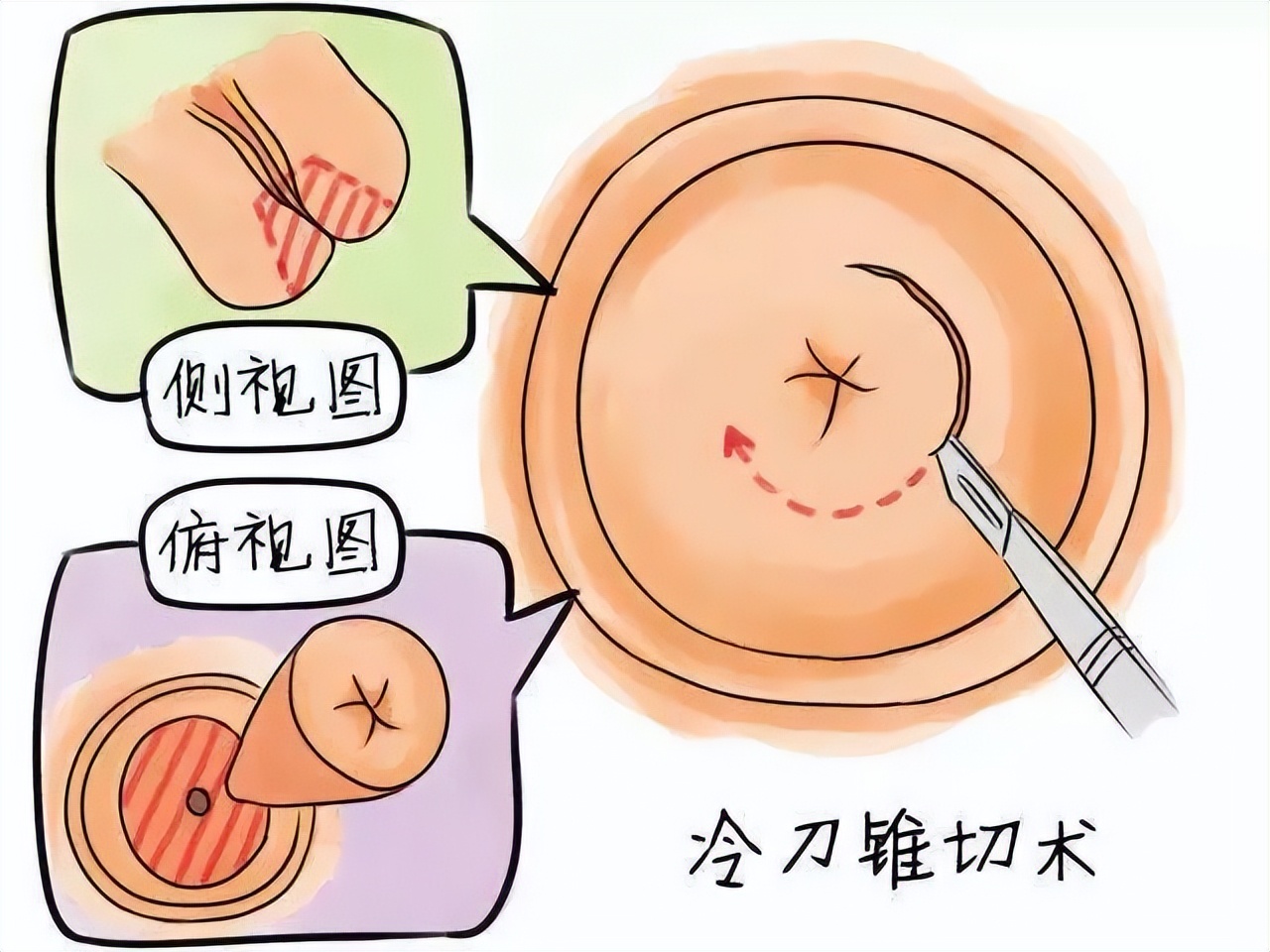 因为TA，33岁女士与宫颈癌擦肩而过！浙一妇科专家：会传染务必当心