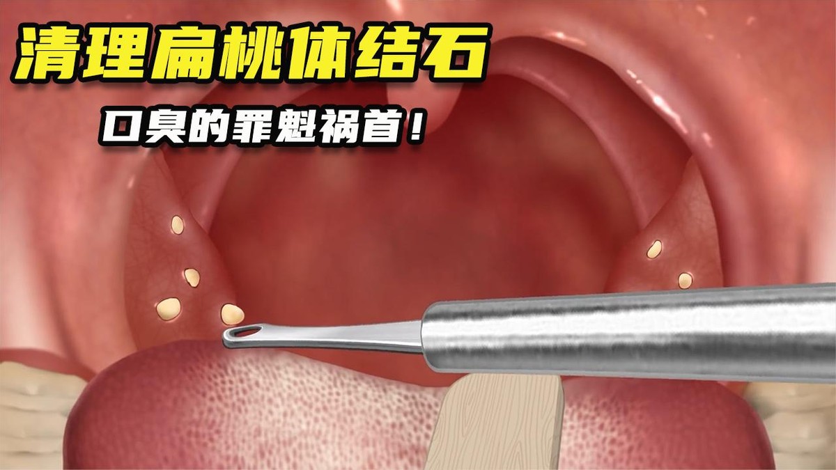 喉咙有异物感咳一下喉咙容易出血,喉咙有异物咳出水老是想咳