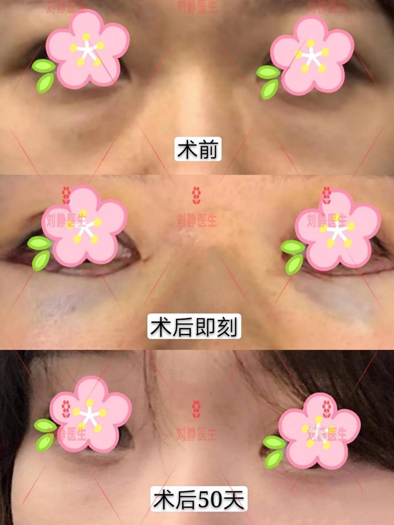 如何消除眼袋下的皱纹的方法,如何消除眼袋黑眼圈的按摩手法