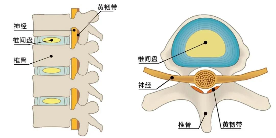 腰椎管狭窄腰腿痛间歇性跛行,腰椎管狭窄压迫神经腿麻木怎么治