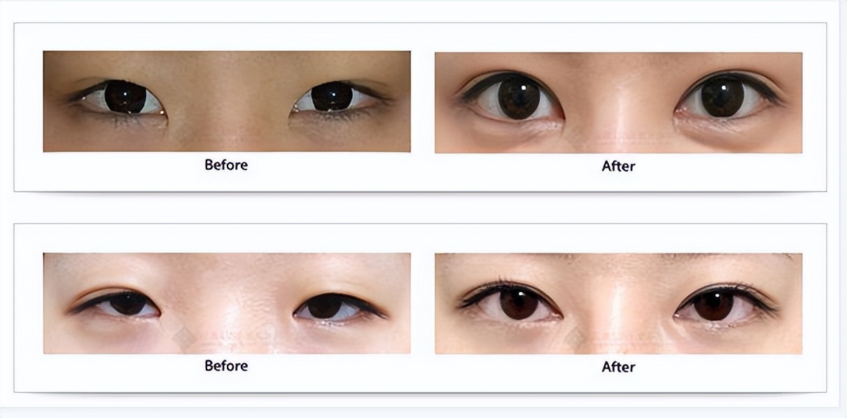 埋线双眼皮疼吗,做双眼皮手术疼吗