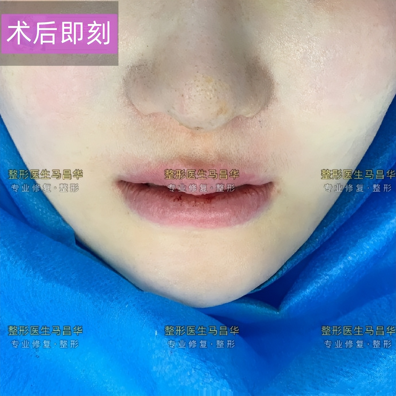 法令纹最好有效的去除方法,有法令纹最好的解决办法真实有效