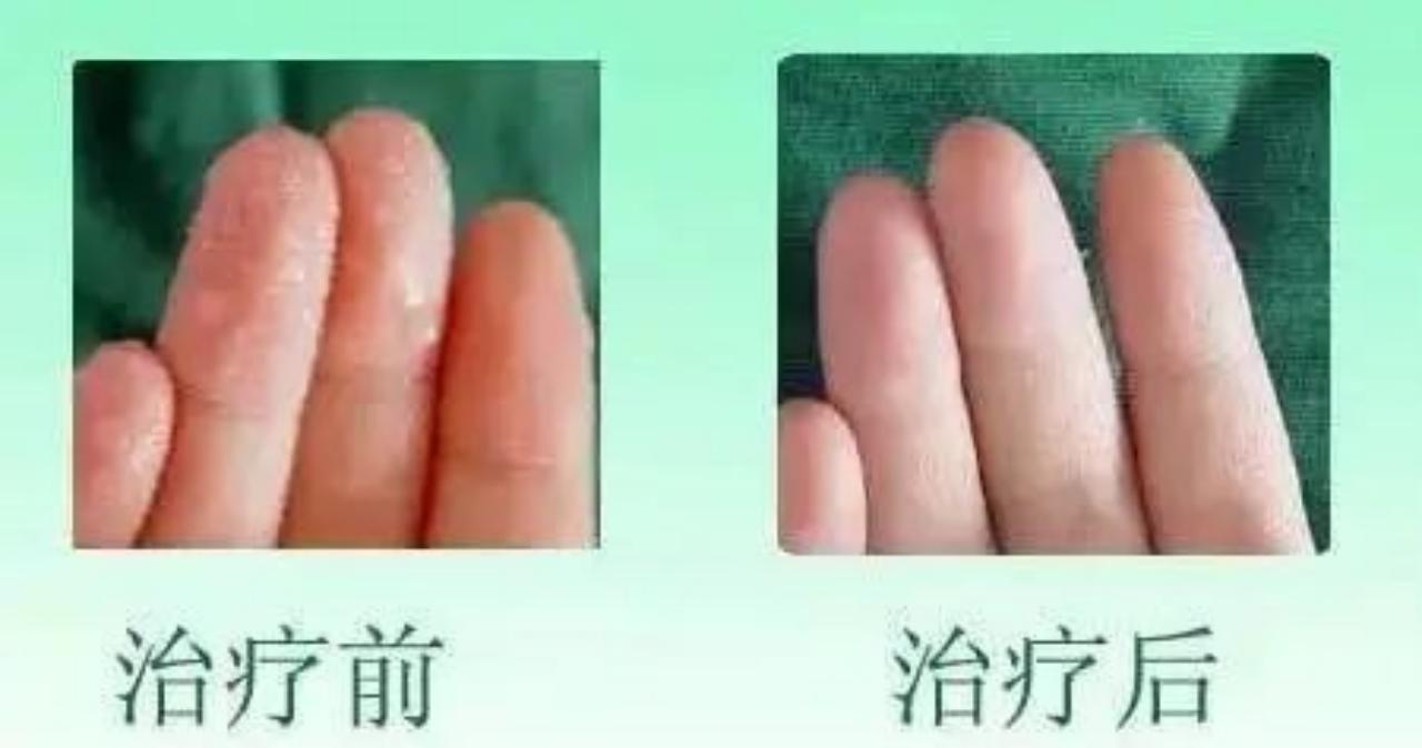 手心出汗是因为着急吗？不，手心总大量出汗是手汗症，要治疗