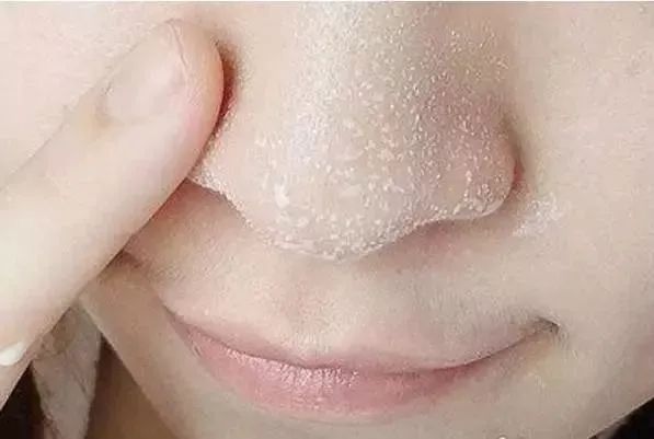 怎样才能彻底跟黑头说拜拜呢,科普如何让烦人的黑头消失