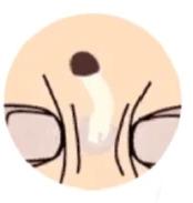 为什么说挤痘痘很危险,为什么说挤痘痘是往里面挤