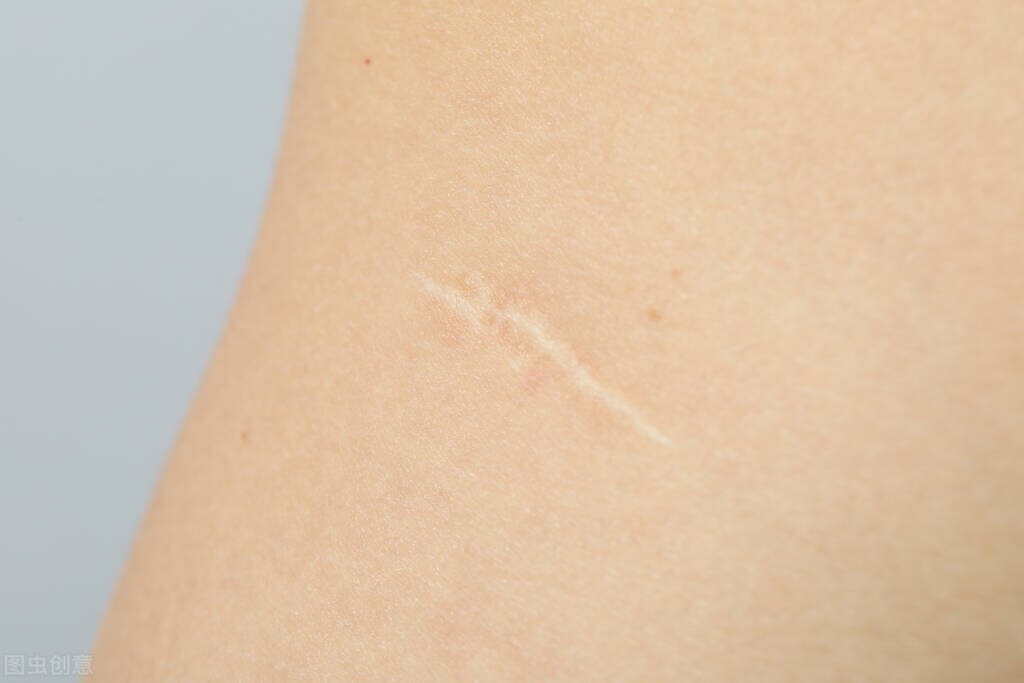 瘢痕疙瘩和增生性疤痕,瘢痕疙瘩是异常增生引起的吗