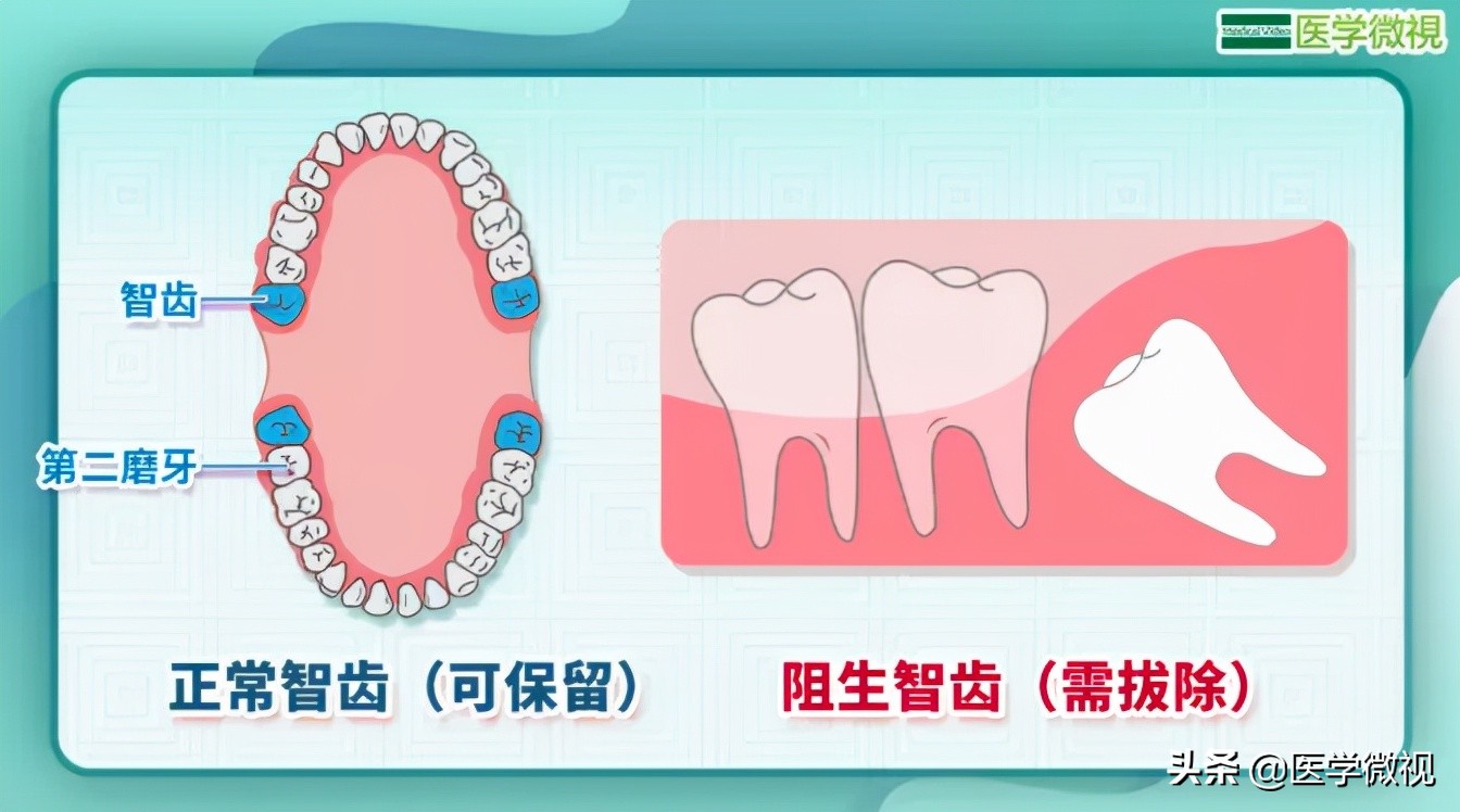 拔智齿是硬把牙拽下来吗,拔智齿到底要不要拔掉