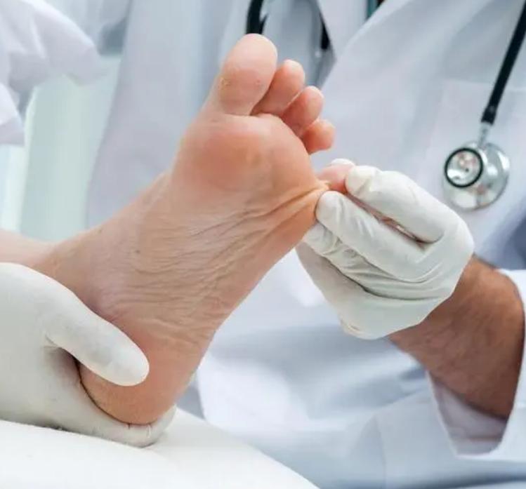 脚气真菌怎么治才能除根,脚气真菌怎么彻底消灭