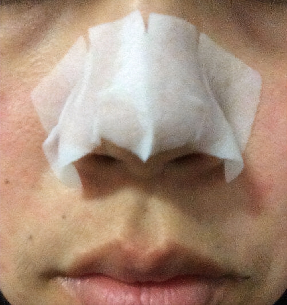 额头眉心发红有闭口粉刺,眉心鼻头频繁起粉刺怎么办