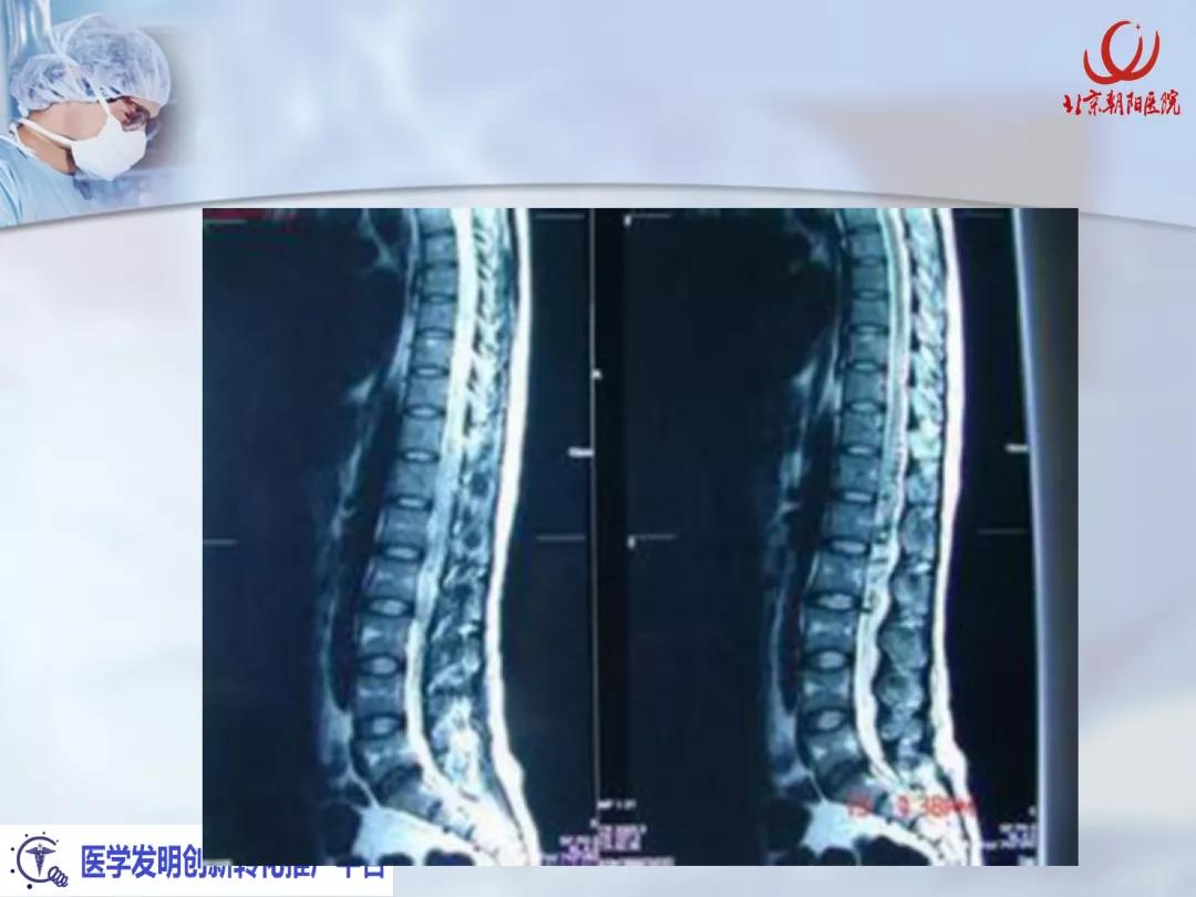 课件分享丨腰硬联合麻醉后，患者脑脊液持续漏出，怎么办？