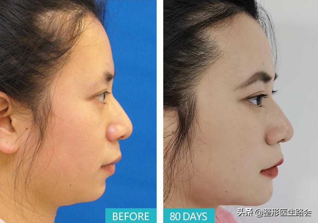 瞒着老爸，在北京隆下巴：22岁东*姑北**娘80天甩掉“肉乎乎包子脸”