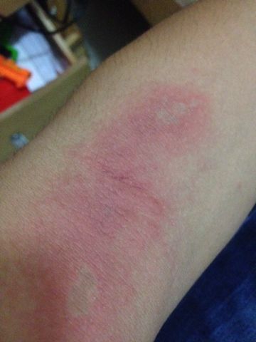 经常喝酒，皮肤痒、阴部潮湿、舌苔黄厚腻？用好这个方