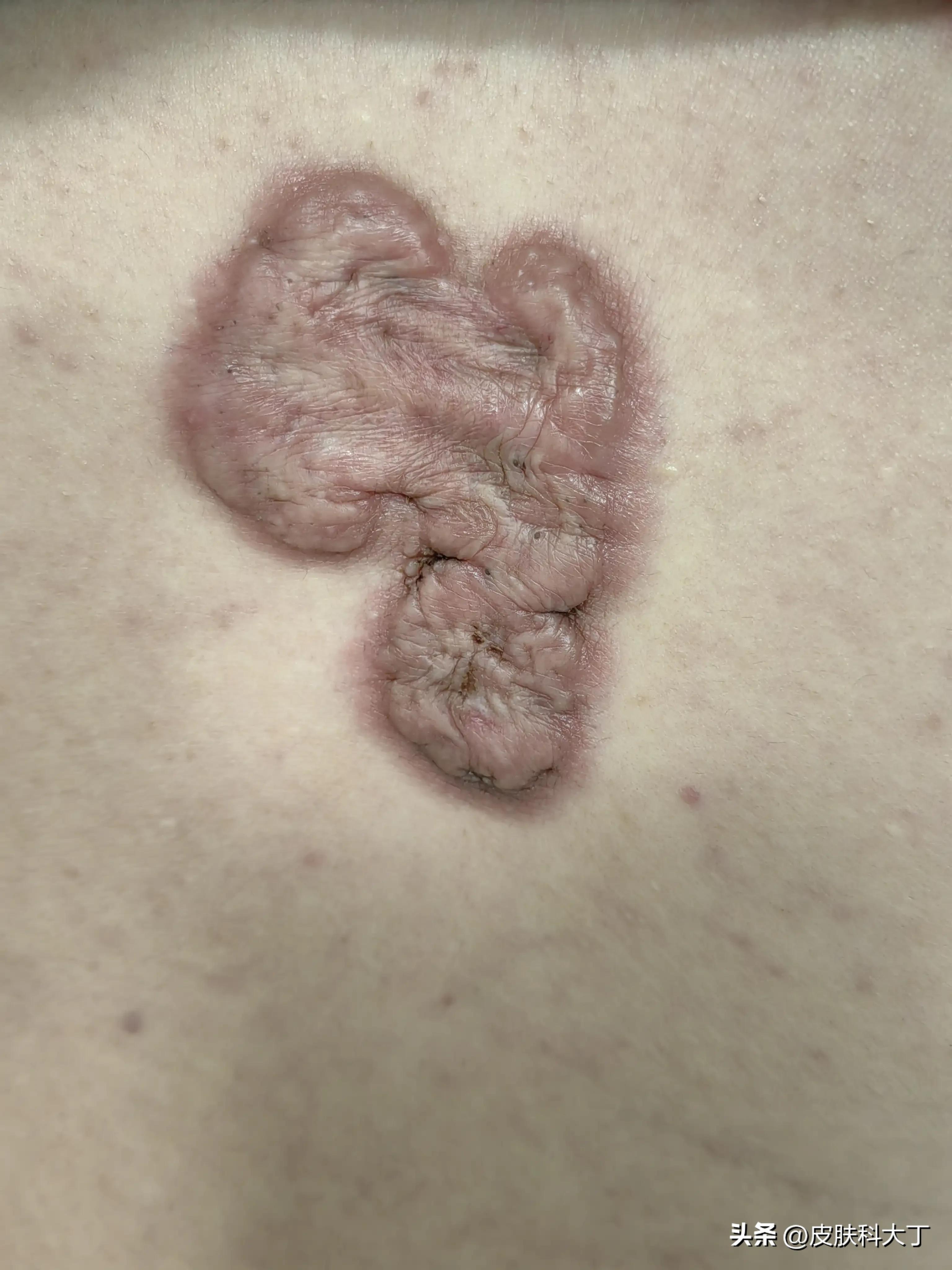 脸上的痣用激光点会留疤吗,脸部激光点痣后的注意事项