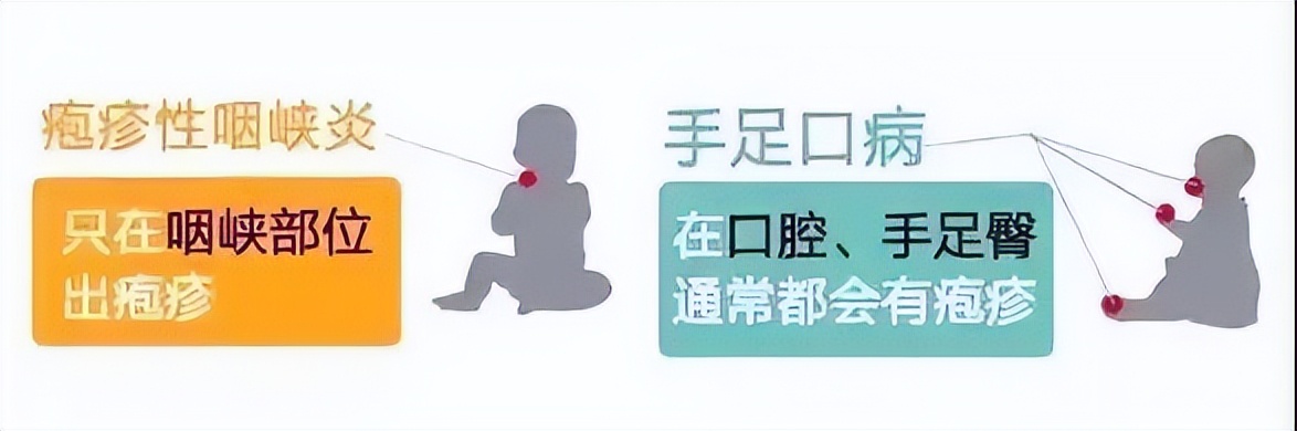 疱疹性咽峡炎怎么护理治疗好得快,儿科疱疹性咽峡炎护理诊断