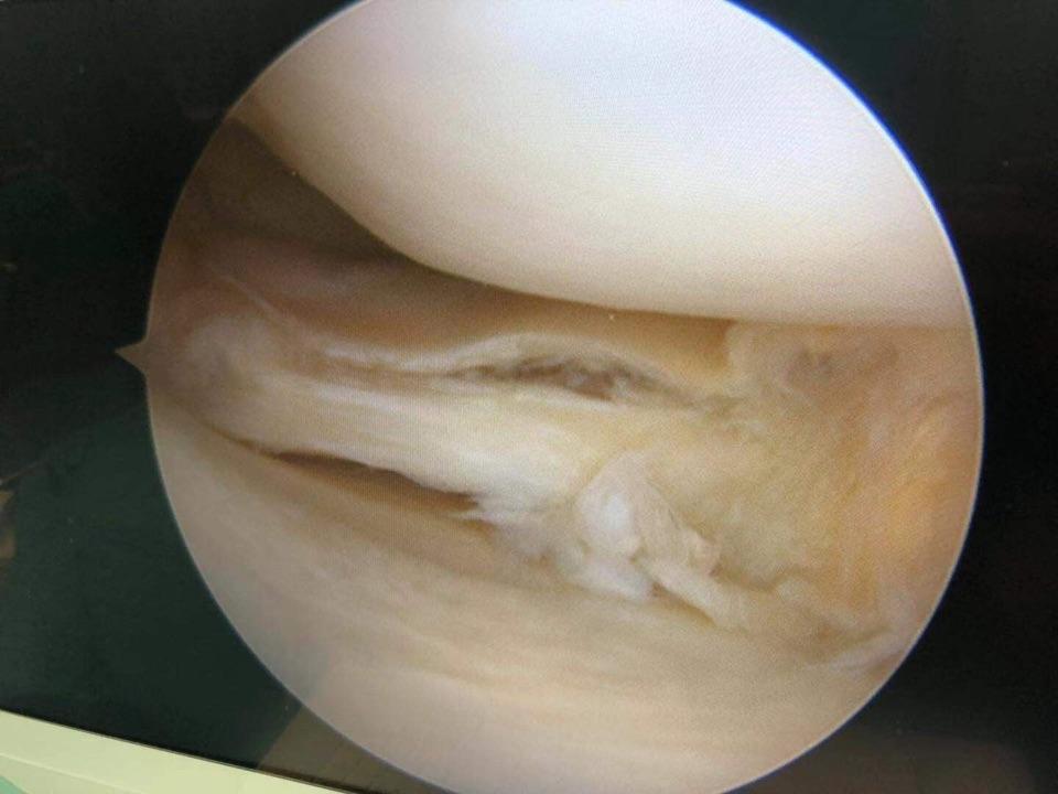 富血小板血浆因子作用,富血小板血浆治疗的目的和意义