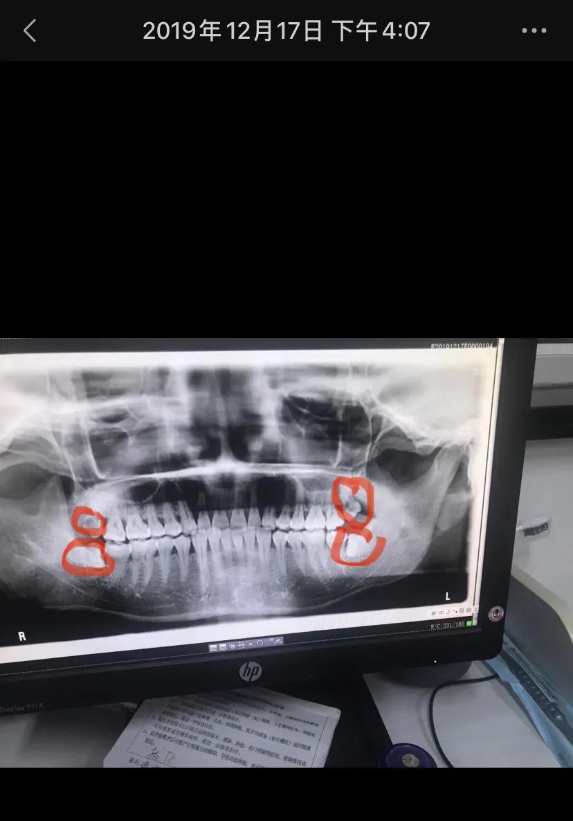 拔除智齿后洞多久愈合,4颗智齿拔掉一颗会怎样