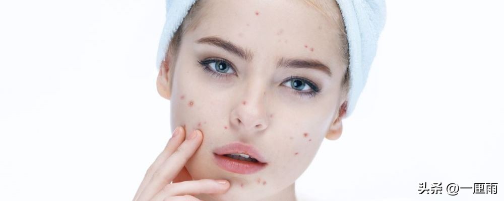 脸上起痘祛痘印的最佳方法,脸上痘痘痘印很严重如何快速祛痘