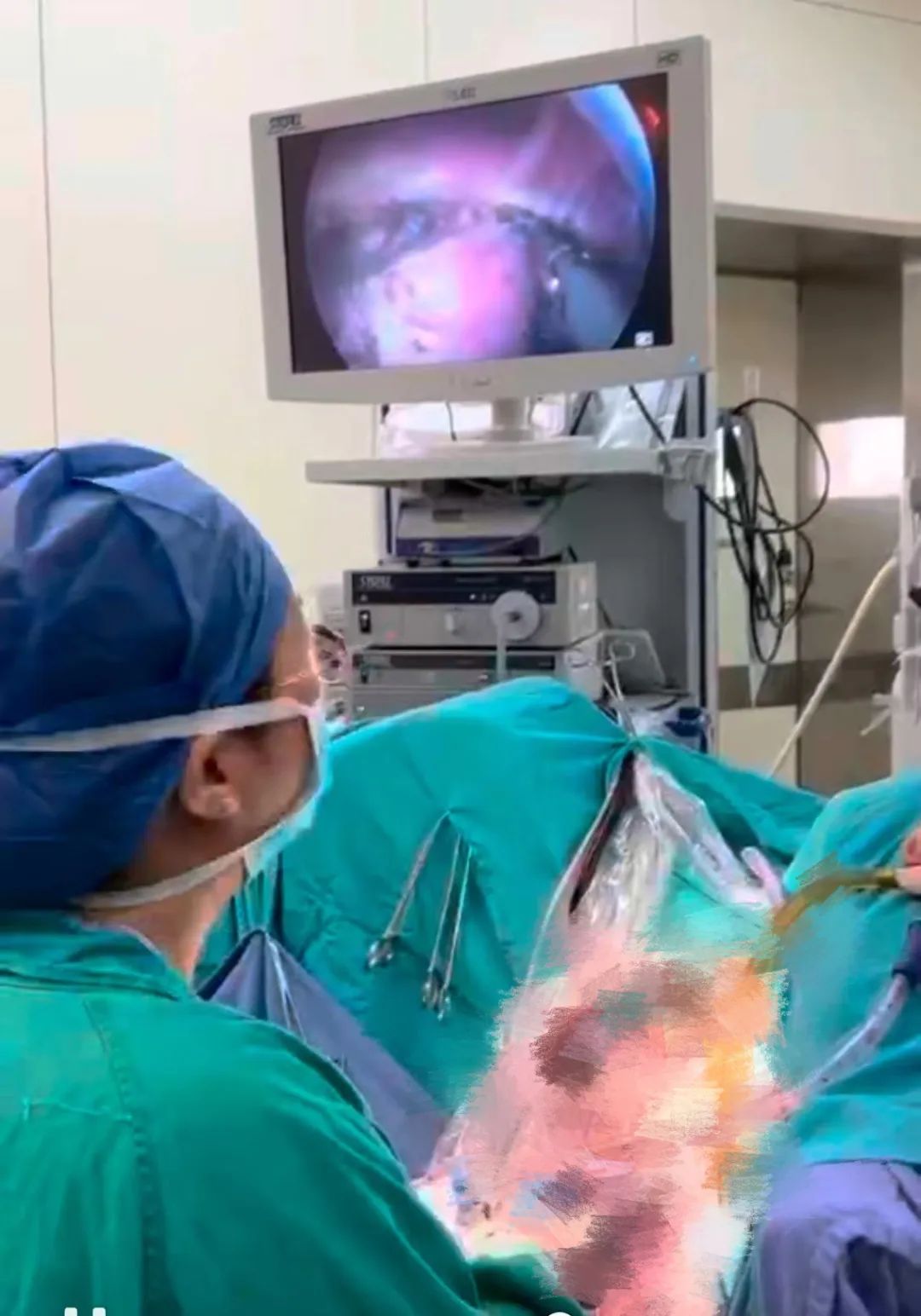 腹腔镜手术腹部有切口,腹腔镜手术为什么肚子上没有疤痕