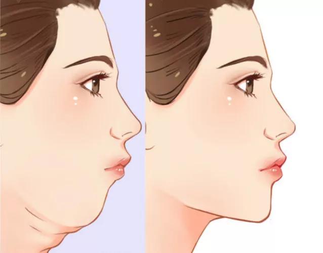 改善双下巴应该做什么医美项目,双下巴怎么改善最有效