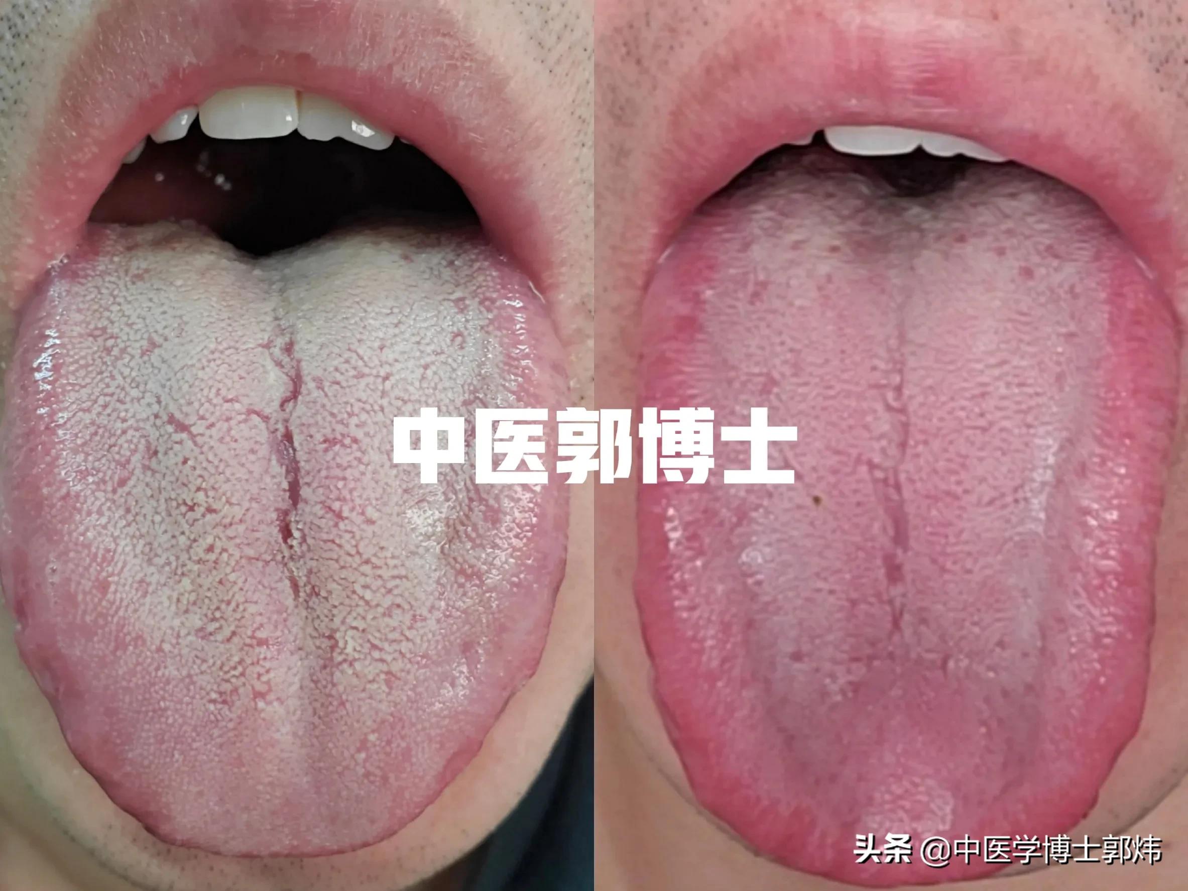 口腔溃疡用了西瓜霜反而更严重了,口腔溃疡西瓜霜没用怎么治