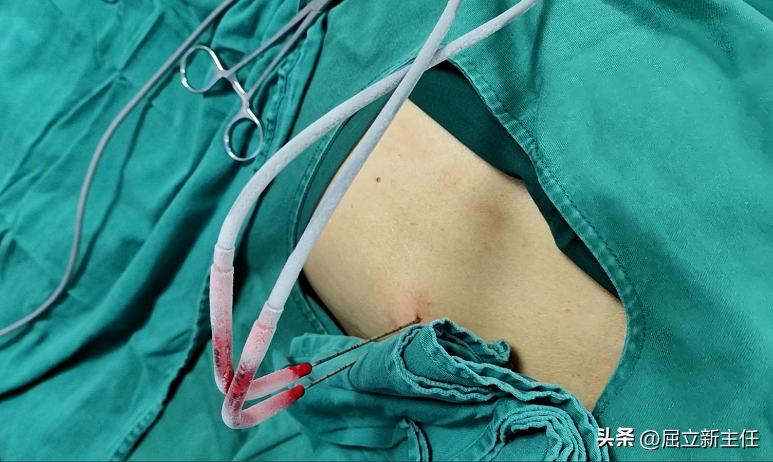 腰上长疙瘩检查是癌症,发现肝上长肿瘤就要动手术吗