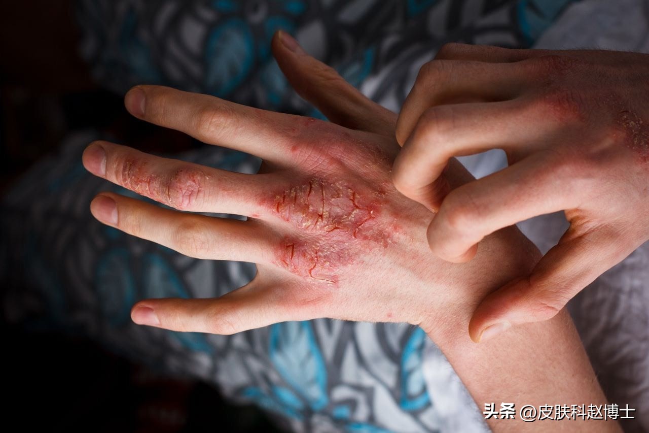 手部角化性湿疹无法痊愈,儿童手部湿疹用什么药膏