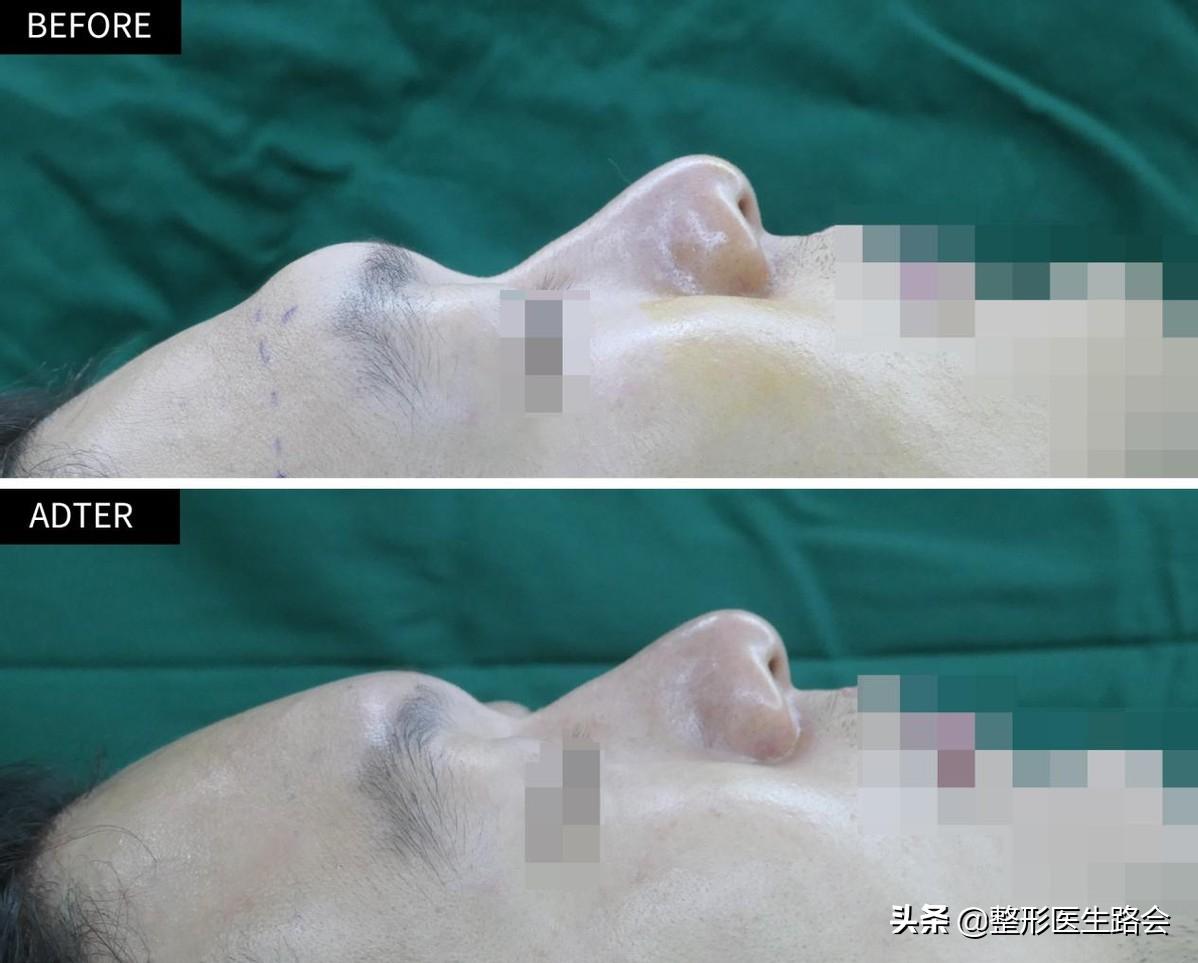 填充额头出现凹坑过于饱满,额头填充怎么避免踩坑