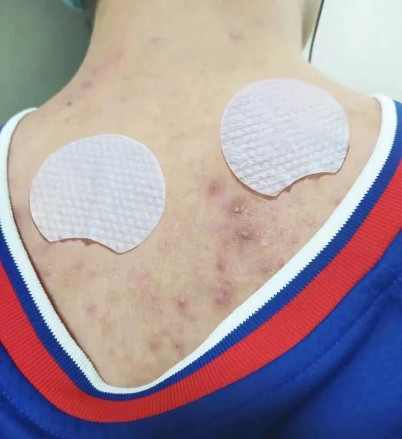 满背的痘痘用什么药,痘痘反反复复如何祛痘