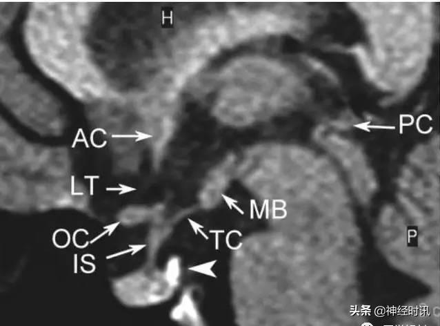 下丘脑及垂体解剖结构,下丘脑解剖和机能特点英文版