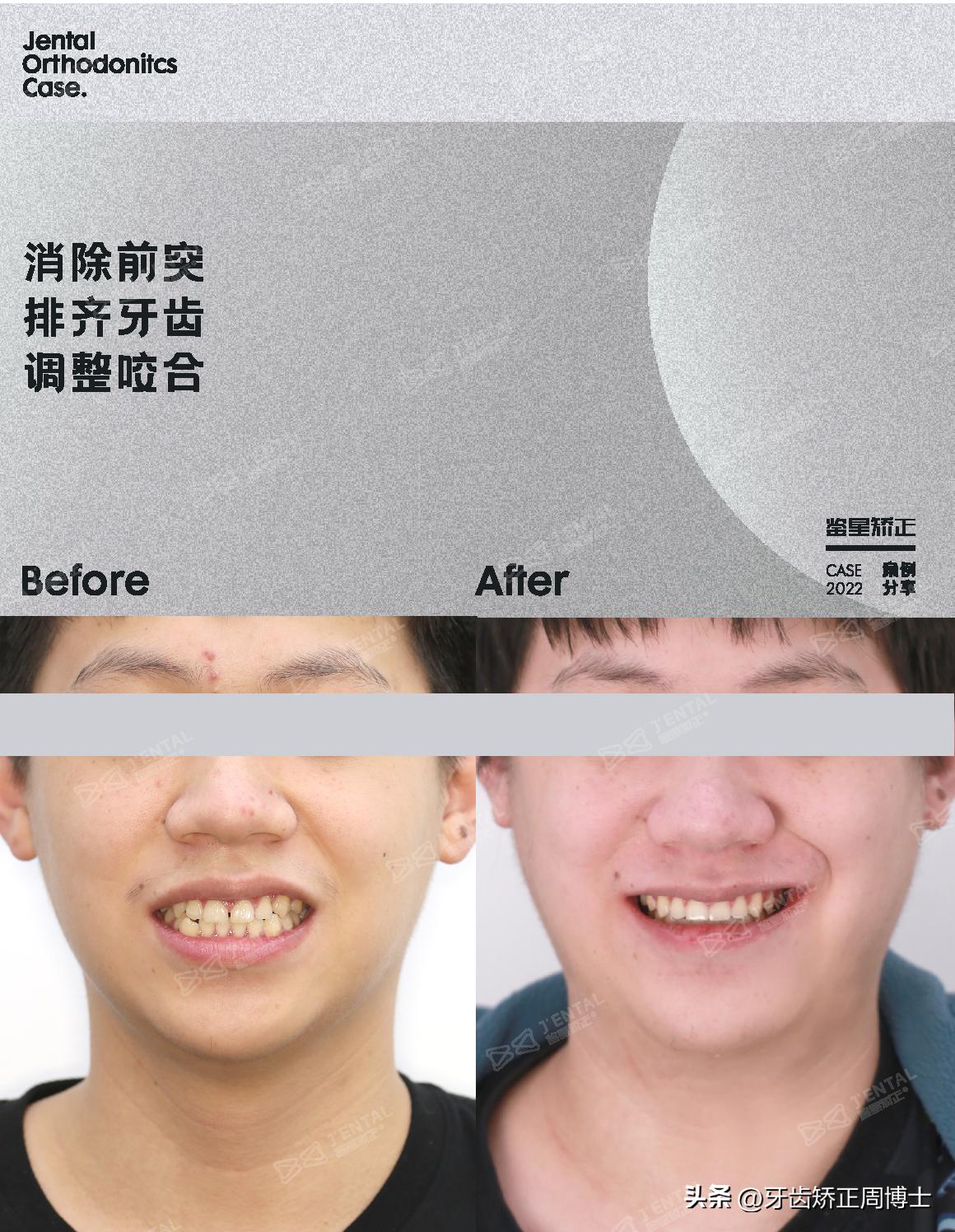 小孩牙齿为什么迟迟不长,孩子牙齿刚长出来不齐怎么办