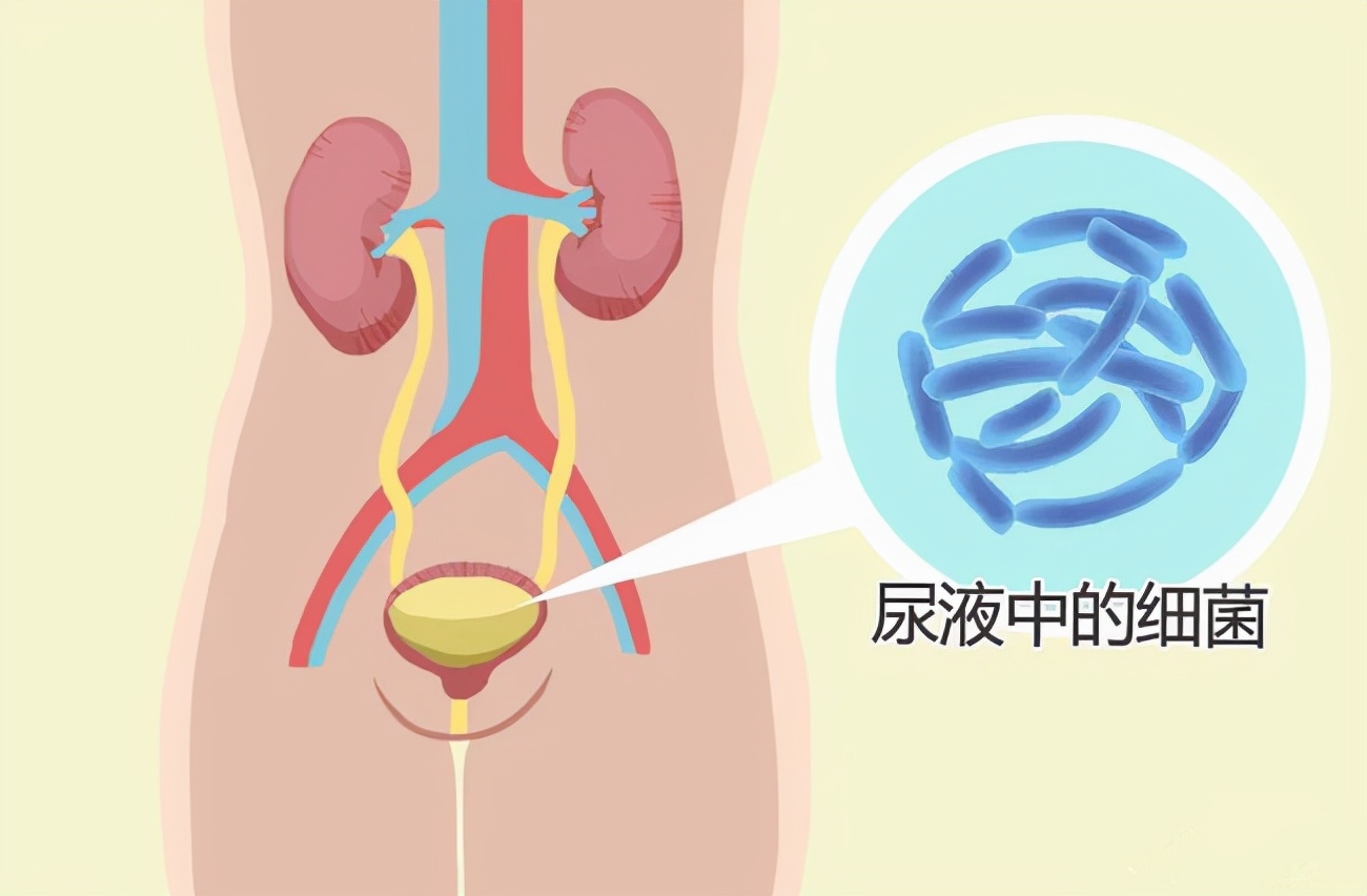 尿路感染反反复复治愈的秘诀,尿路感染吃药好了又复发了怎么办