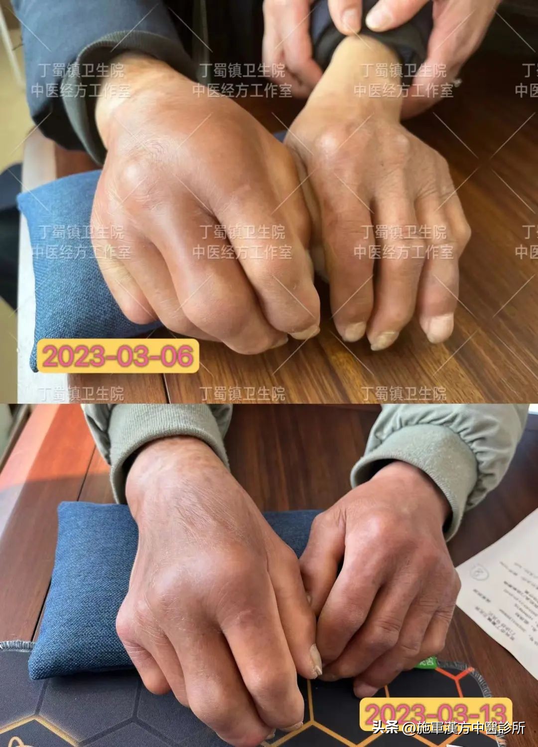 面红发热痒中医经方治疗,手背发热中医经方