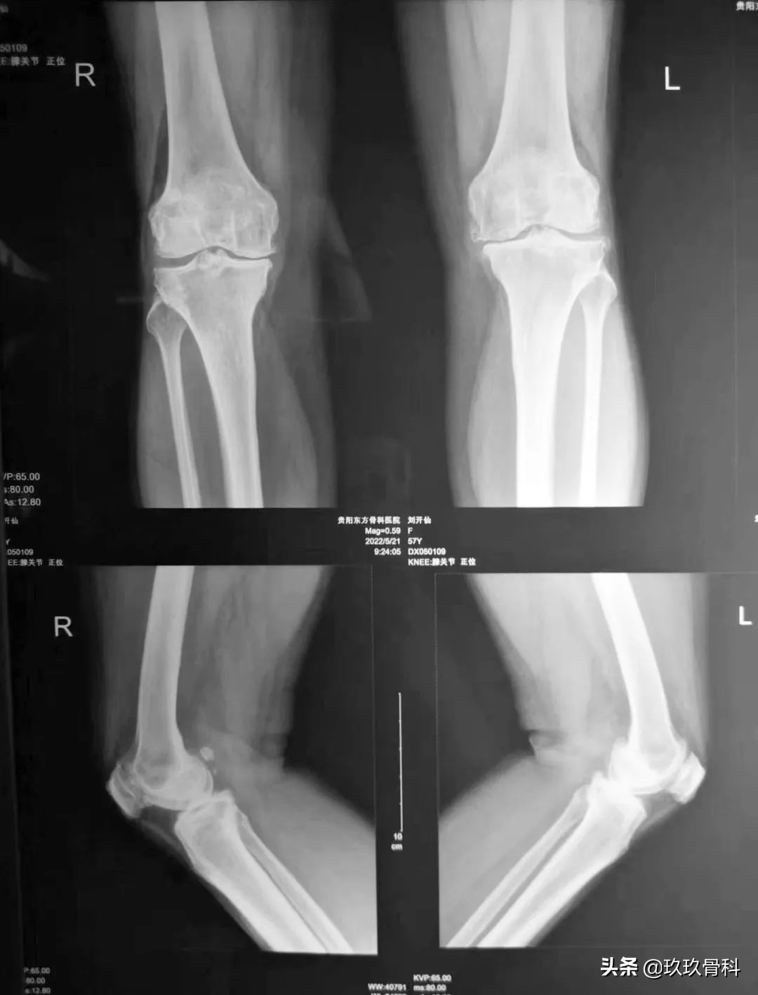 贵阳东方骨科医院膝关节置换,骨科单髁置换手术