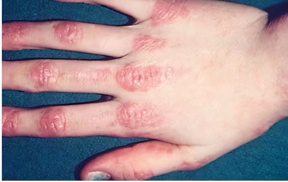 风湿免疫类疾病最怕什么,风湿免疫疾病如何预防