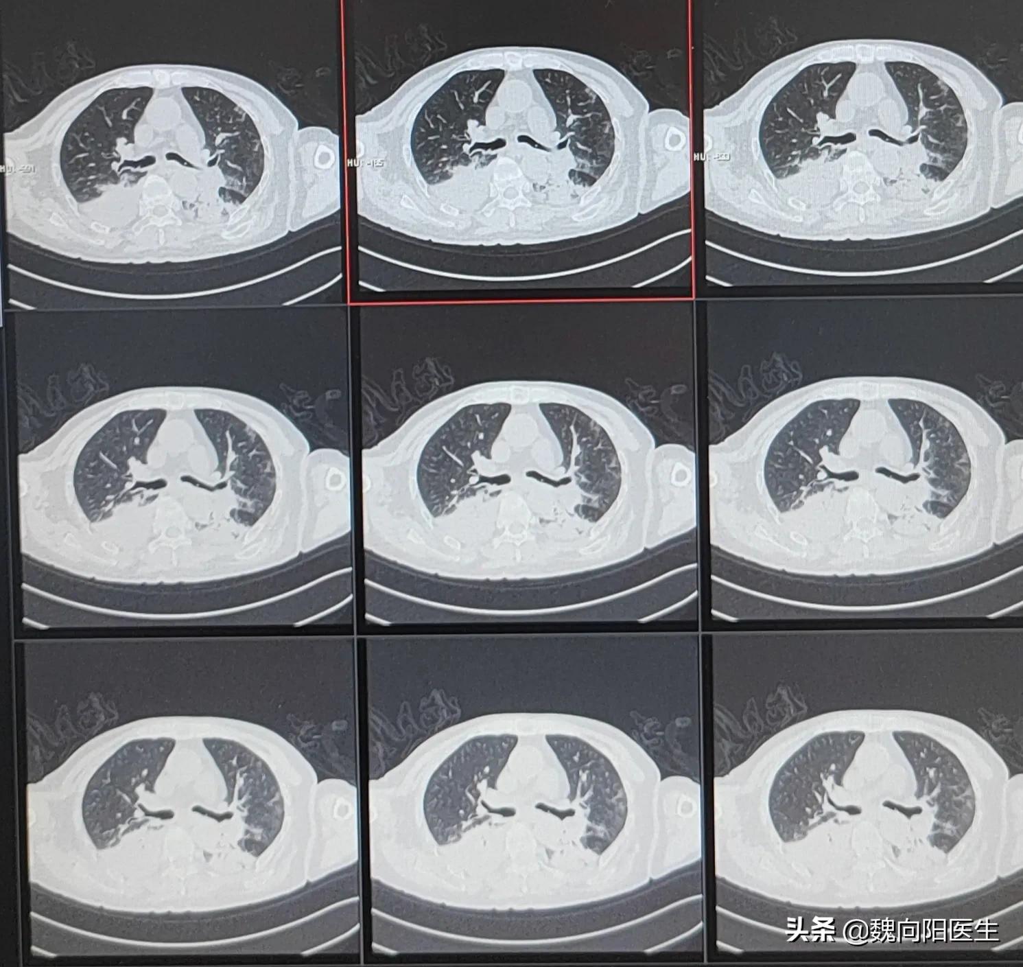胃溃疡病人不配合插胃管怎么办,下胃管进食胃会不舒服吗