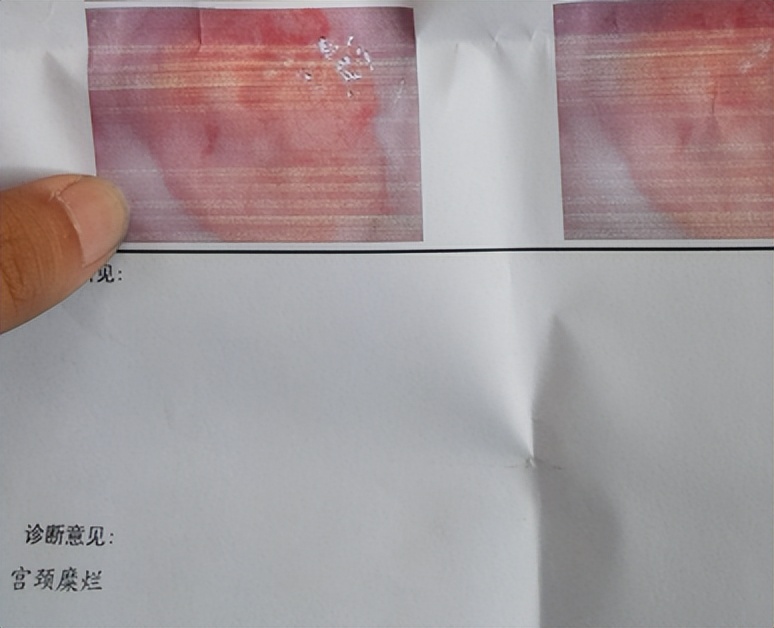 女孩腹痛就医，医生检查发现其阴道处的紫蓝色膨隆，立即引起重视