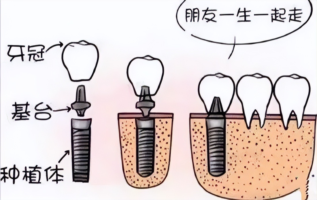 种植牙有什么风险和后遗症吗,种植牙有什么危害会有什么后果