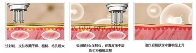 水光针多久可以护肤,水光针多长时间能护肤