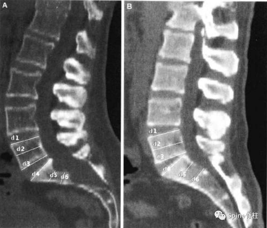 硬膜扩张,duralectasia