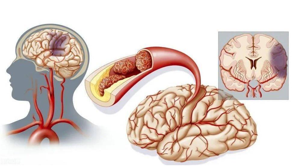 脑梗吃什么中成药可预防脑梗复发,中老年如何预防脑梗心血管疾病