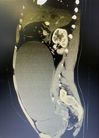 70岁盆腔囊肿10公分可以微创吗,武汉做盆腔囊肿手术哪个医院好