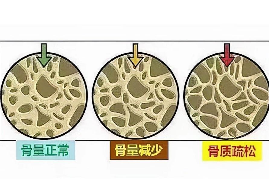 儿童骨密度检测中bmi正常范围,34岁骨密度检测说骨质疏松怎么办