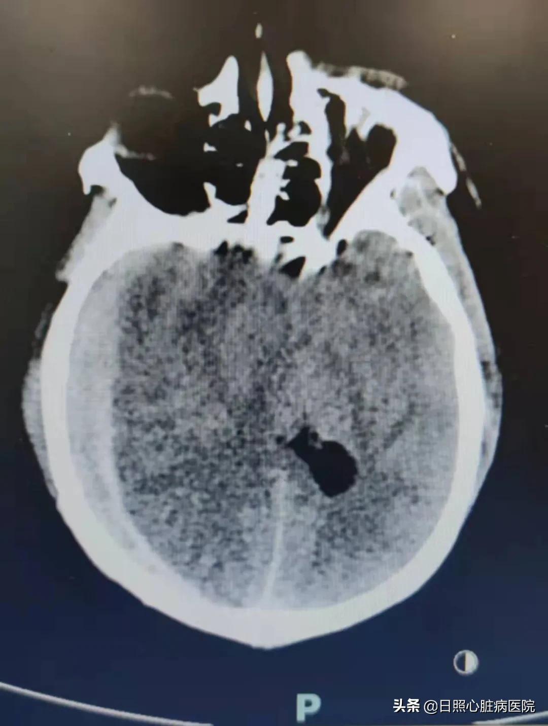 日照心脏病医院成功救治重病患儿,日照心外科医院