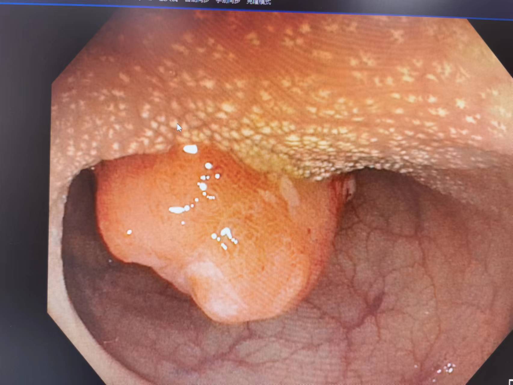 便血怎么分辨痔疮和息肉,便血是肠息肉还是肠癌