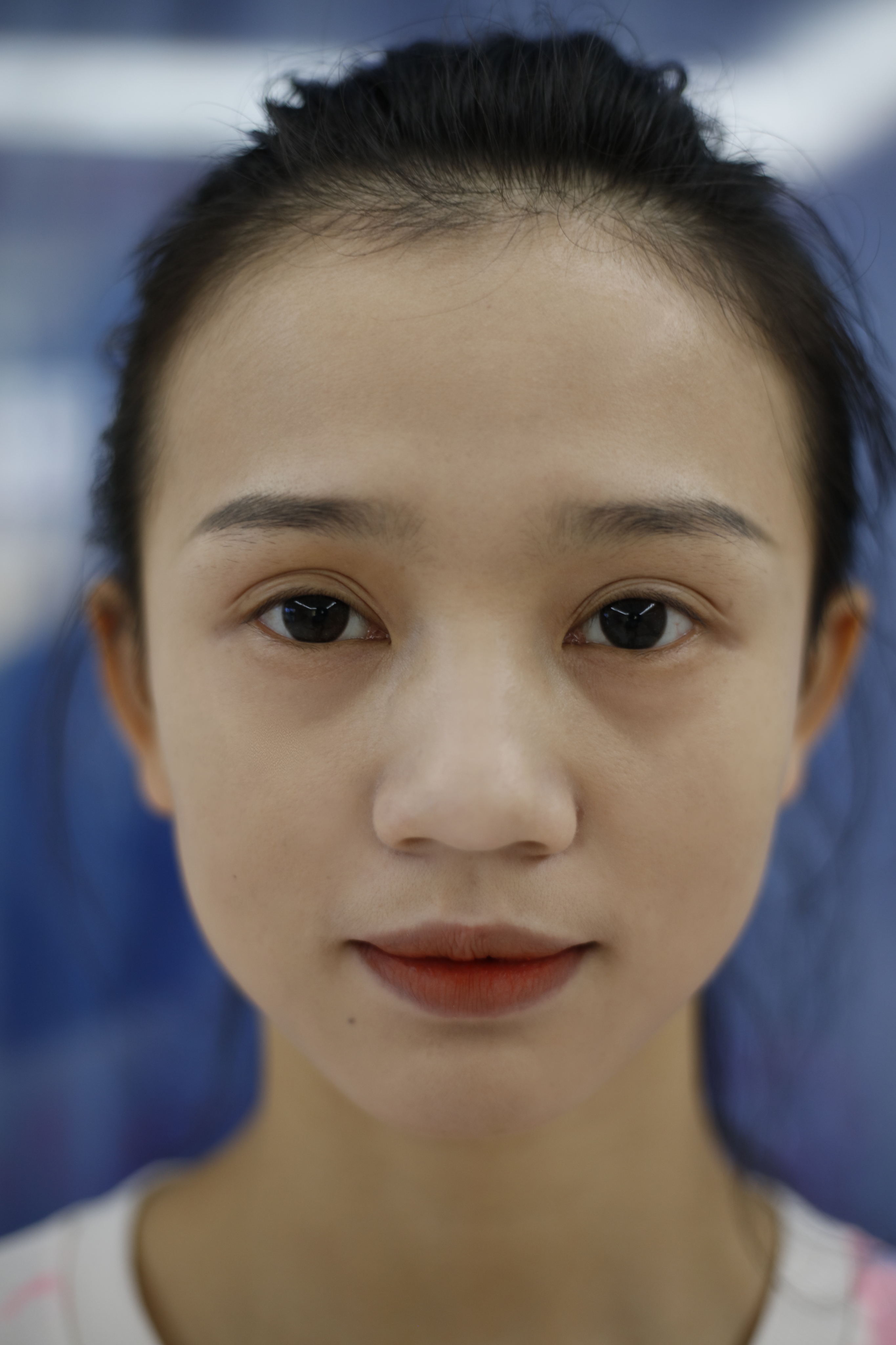 再漂亮的小姐姐也会被痘印困扰，治疗完后感叹激光治疗效果真不错