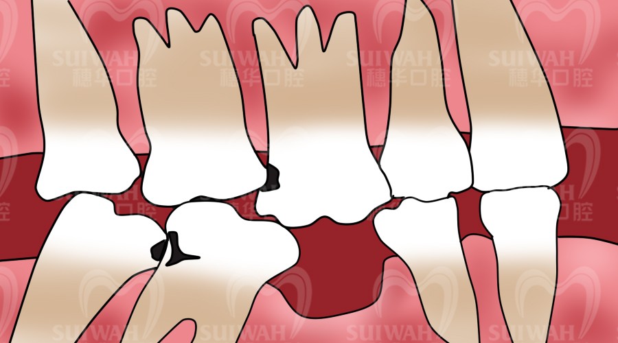 年轻人缺一两颗牙要管吗？真要管